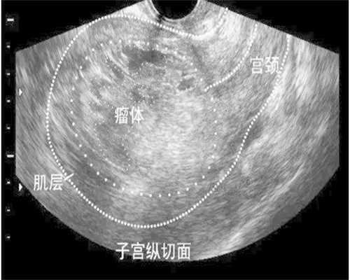 盆腔炎影响代生最便宜成功率有多大？盆腔炎做代生最便宜成功率高吗？