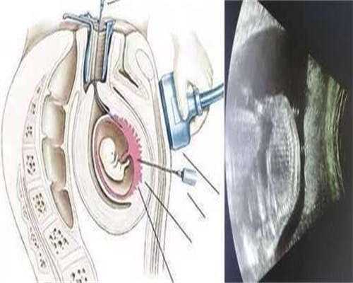 供卵包怀男孩：黄体酮软胶囊保胎注意事项是什么？