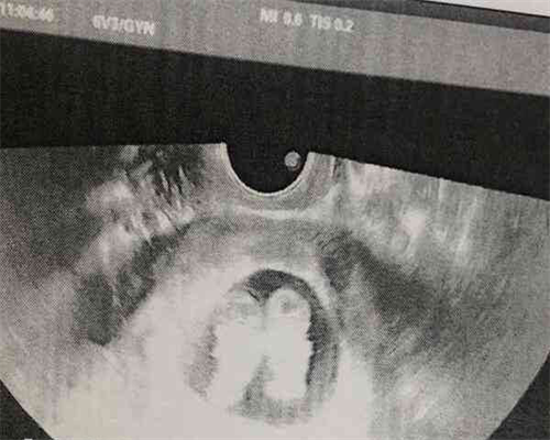 高血压做试管供卵产子成功案例分析(高血压做试管供卵产子成功案例分析报告